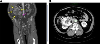 Innovative Technical Solution Using the Renal Artery Stump after Nephrectomy as an Inflow Artery for Lower Limb Revascularization—A Case Report